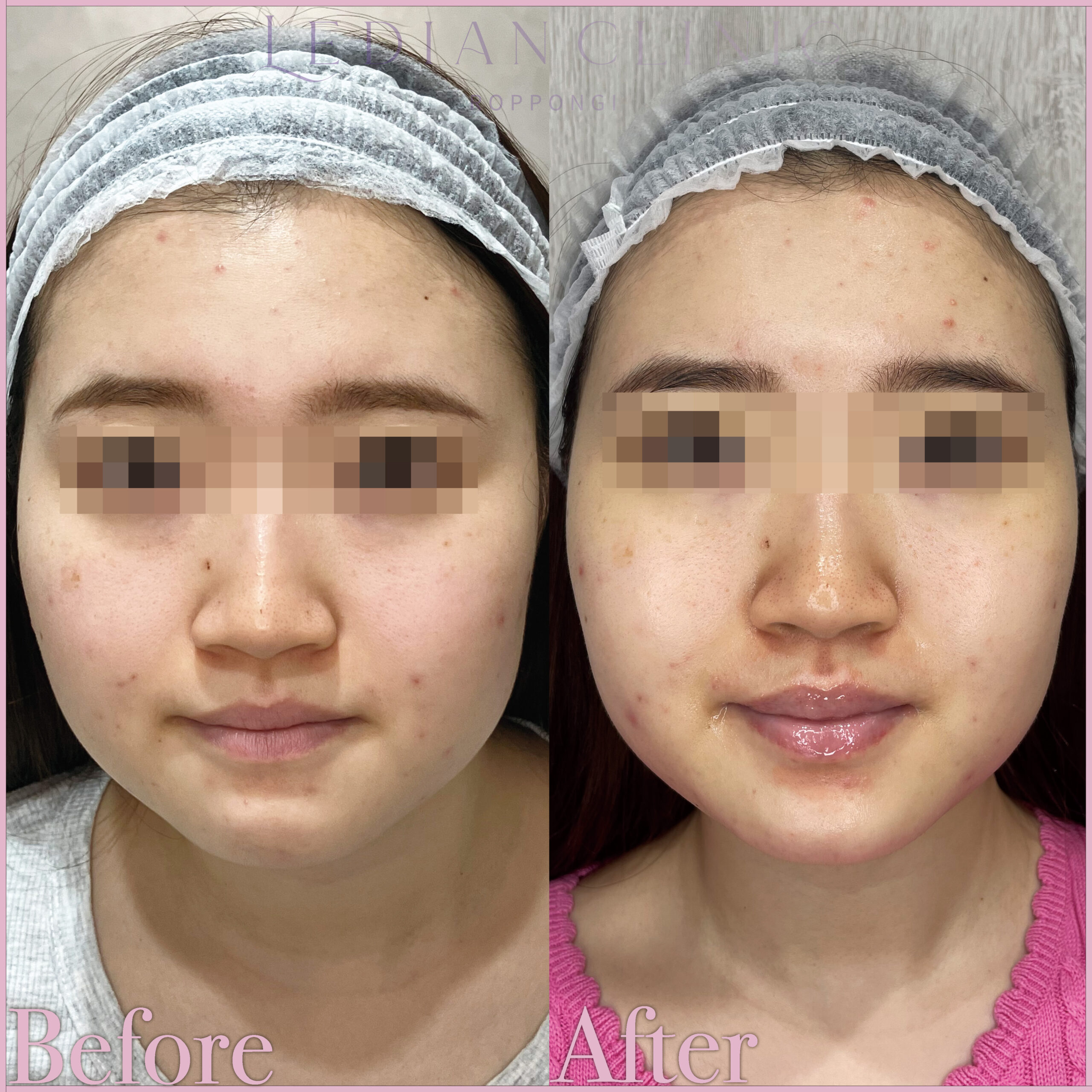 【Before / After】After photo taken 1 month later.