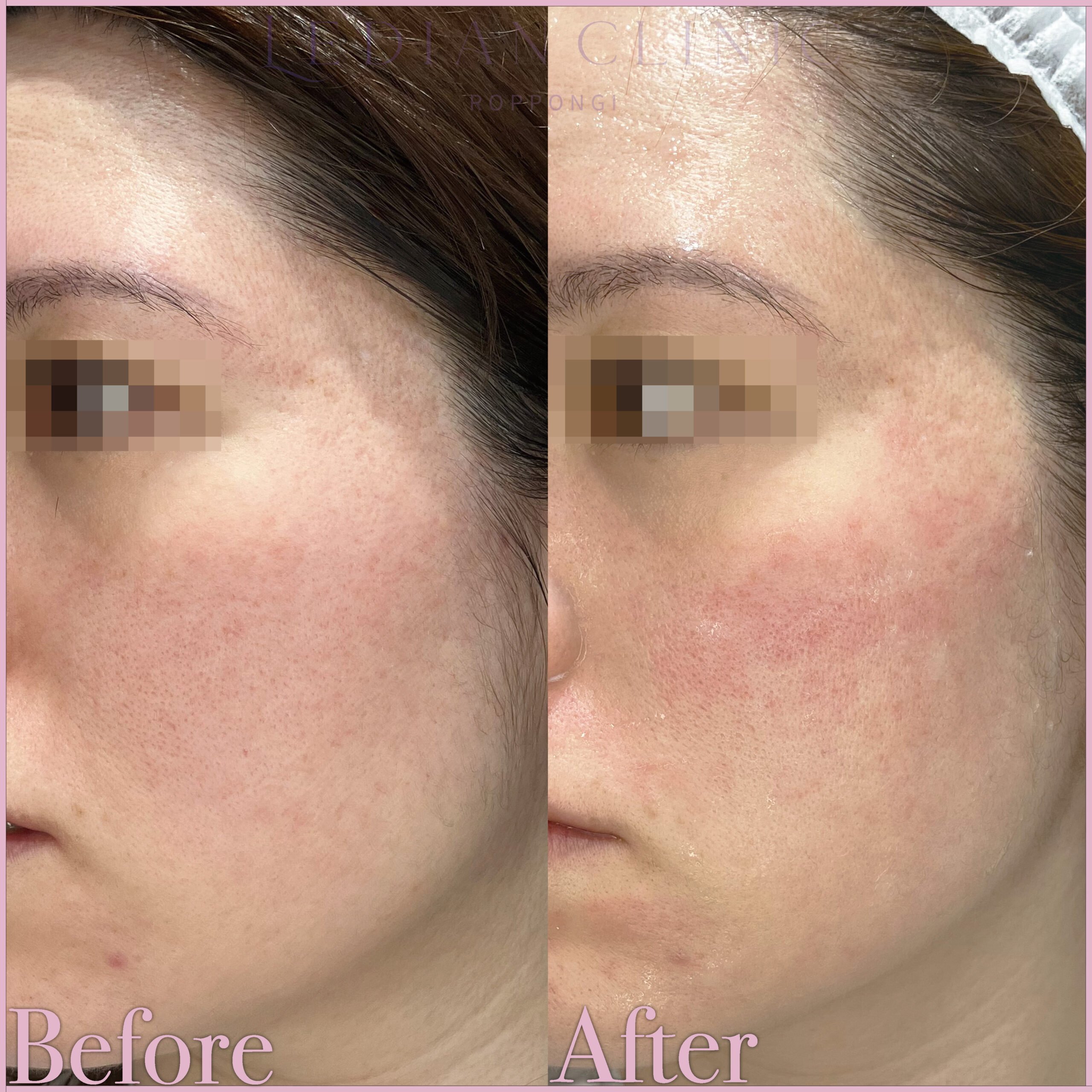【Before / After】After photo taken 1 month later.