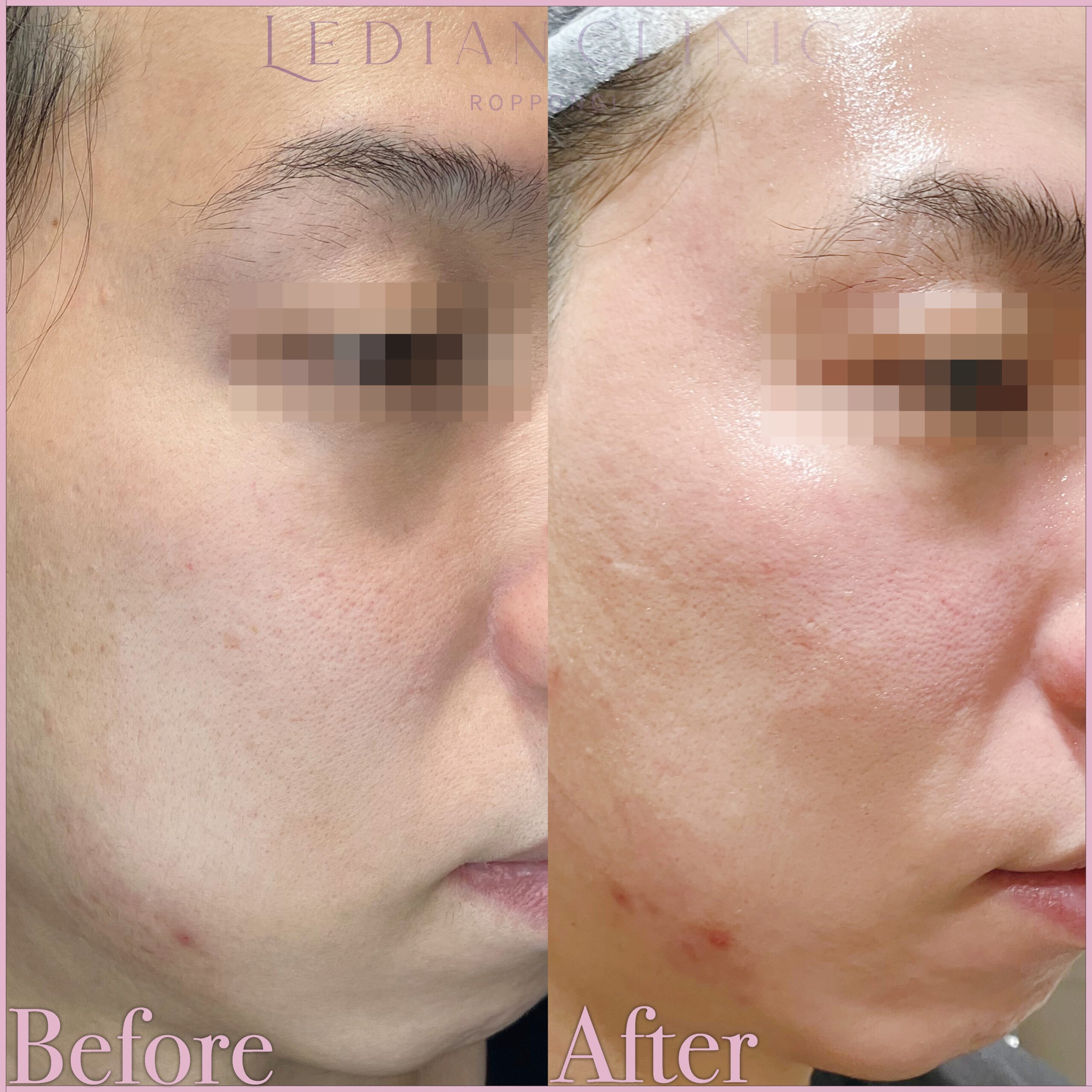 【Before / After】After photo taken 1 month later.