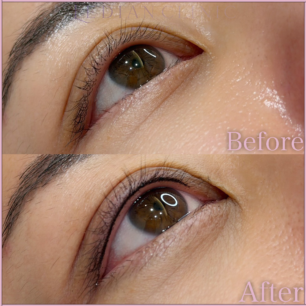 【Before / After】Number of treatments: 1